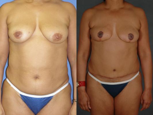 TRAM flap breast reconstruction