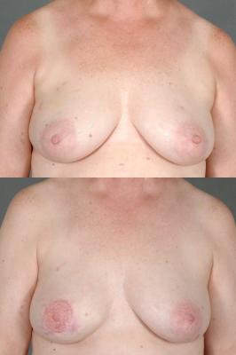 TRAM Flap Breast Reconstruction