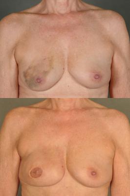 TRAM flap breast reconstruction