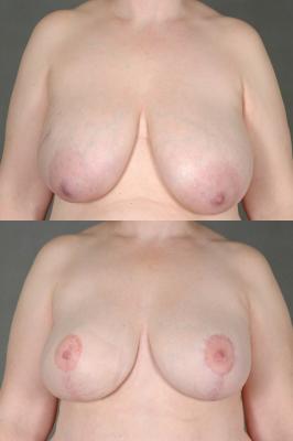 TRAM flap breast reconstruction
