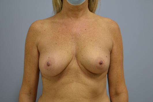 Before- Breast Reconstruction Oncoplastic Reduction and balancing augmentation