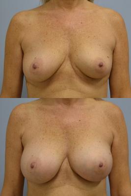 Before(top pic) After (bottom pic): Breast Reconstruction Oncoplastic Reduction and balancing augmentation