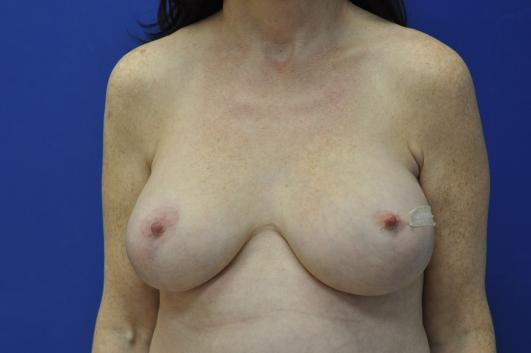 Before- Breast Reconstruction 