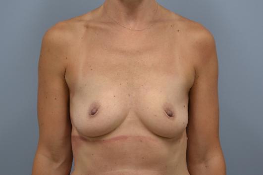Before- Breast Reconstruction 