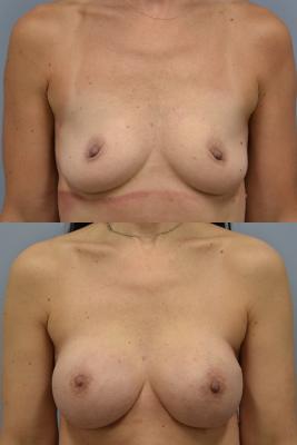 Before (top pic) After (bottom pic)-Breast Reconstruction