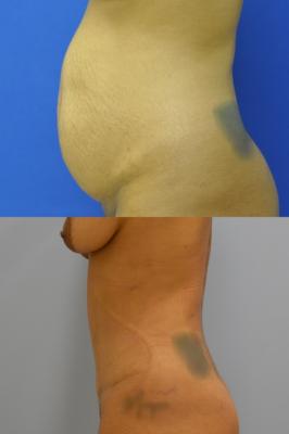 Abdominoplasty with Lipo 360 JJ1