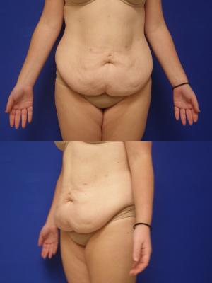 Before-Abdominoplasty and 360 liposuction