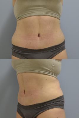 After- Abdominoplasty and 360 liposuction