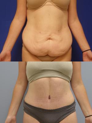 Before (top photo) After (bottom photo)- Abdominoplasty and 360 liposuction