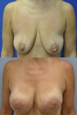 Before(top pic) After (bottom pic): Breast Reconstruction