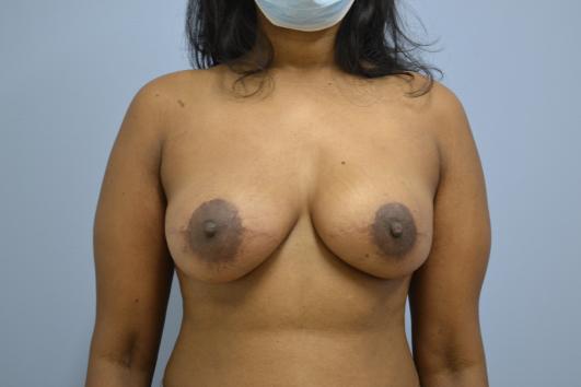 After-Breast Reconstruction