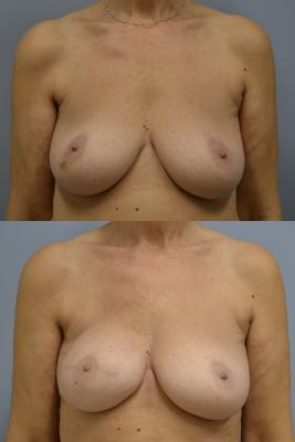 Right Breast Reconstruction
