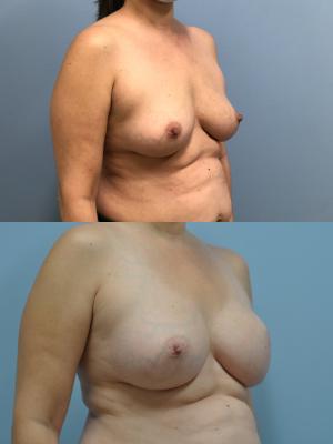 Before (top pic) After (bottom pic)-Breast Reconstruction