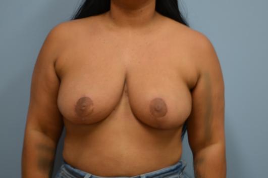 After- Breast Reduction