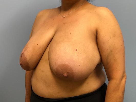 Before- breast reduction