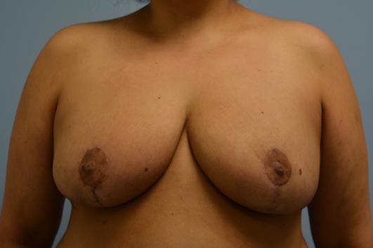 After- breast reduction