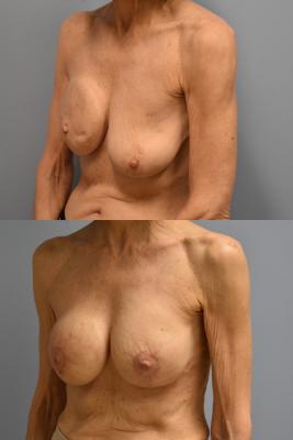Right breast reconstruction, Left breast augmentation and lift