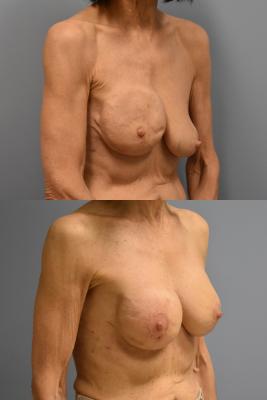Right breast reconstruction, Left breast augmentation and lift