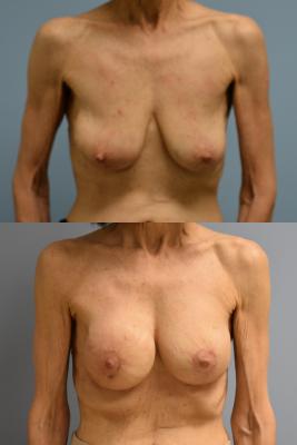 Right breast reconstruction, Left breast augmentation and lift