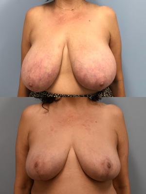 Breast Reduction