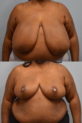 Breast Reduction