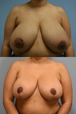 Breast Reduction