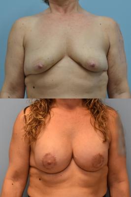 Bilateral breast reconstruction with Tissue Expanders