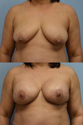Bilateral breast reconstruction with Tissue Expanders