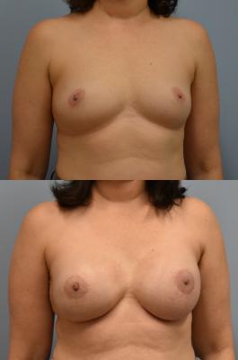 Bilateral breast reconstruction with Tissue Expanders