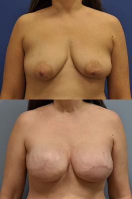 Bilateral breast reconstruction with Tissue Expanders