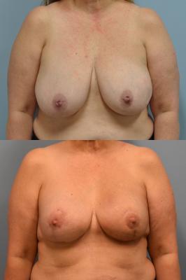 Bilateral breast reconstruction with Tissue Expanders