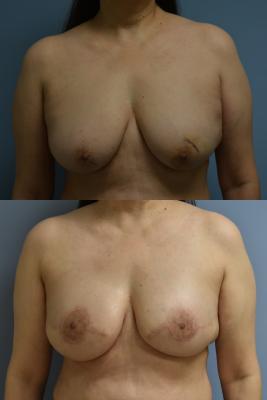 Bilateral breast reconstruction with Tissue Expanders