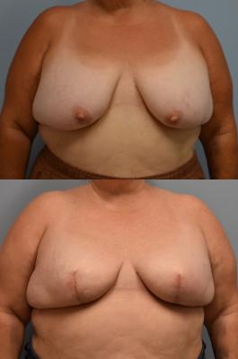 Bilateral breast reconstruction with Tissue Expanders