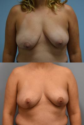 Oncoplastic breast reduction