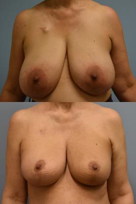 Oncoplastic breast reduction