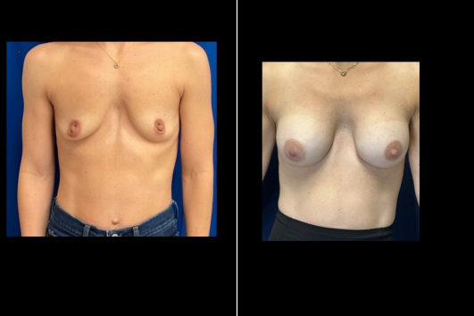 Breast Augmentation-Before and After