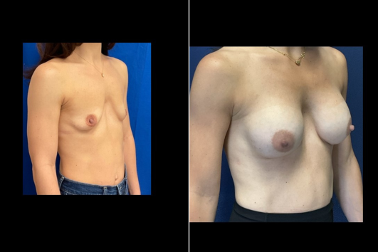 Breast Augmentation-Before and After