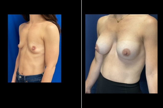 Breast Augmentation-Before and After