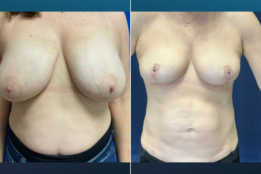 Breast Reduction-Before and After