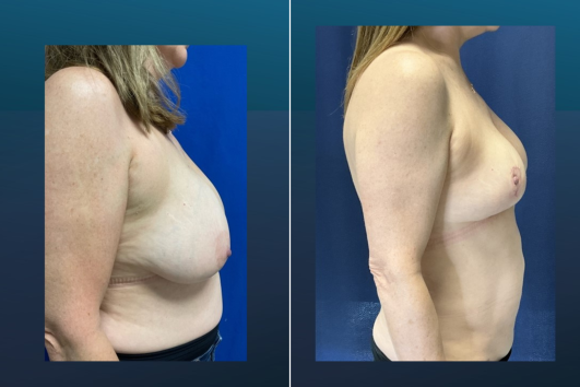 Breast Reduction-Before and After