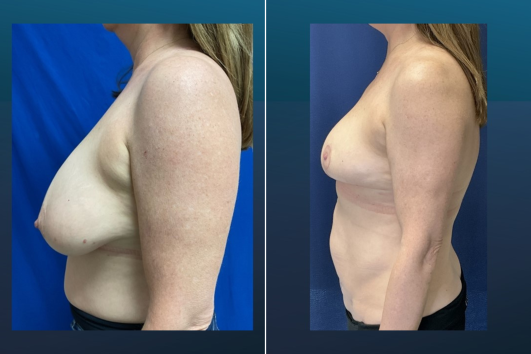 Breast Reduction-Before and After