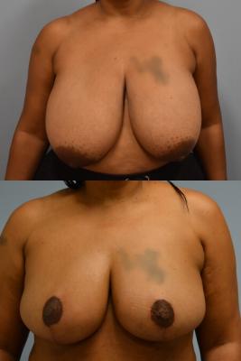 Breast Reduction
