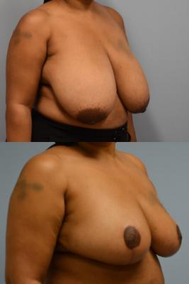 Breast Reduction