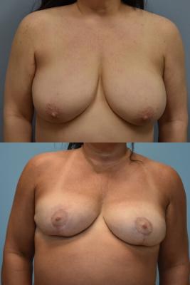 Breast Reduction