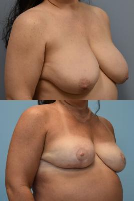 Breast Reduction