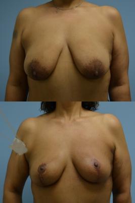 ONCOPLASTIC BREAST REDUCTION