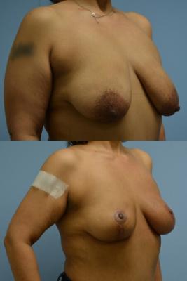 ONCOPLASTIC BREAST REDUCTION