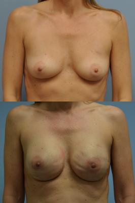 Breast Reconstruction with Tissue Expander