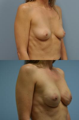 Breast Reconstruction with Tissue Expander
