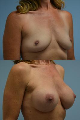 Breast Reconstruction with Tissue Expander